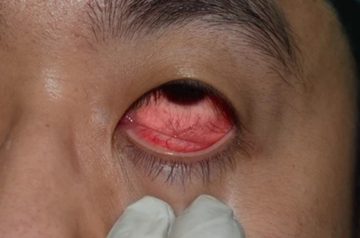 Corneal care