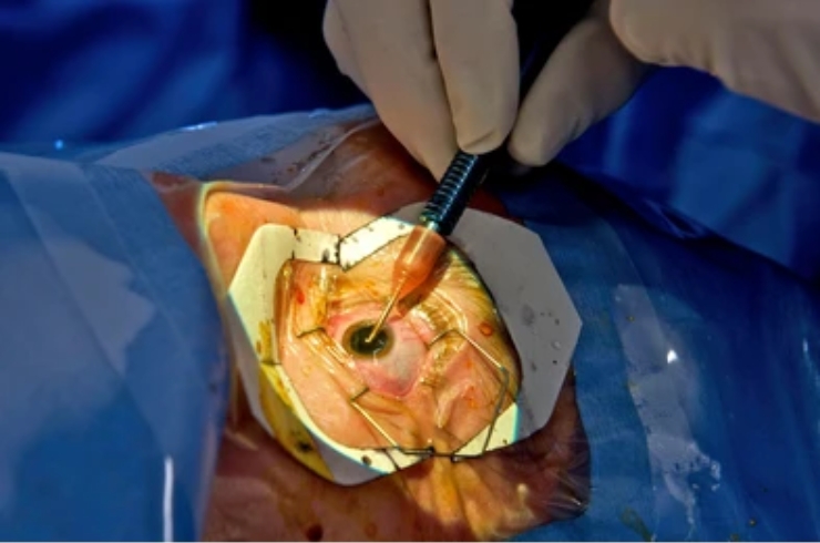 Cataract surgery-----15